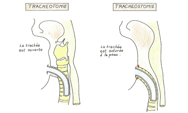 Trachéotomie et trachéostomie